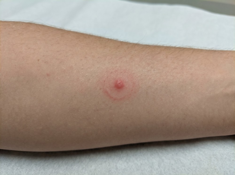 Close-up photo of a mild garden spider bite showing a small red raised bump with faint surrounding redness on skin