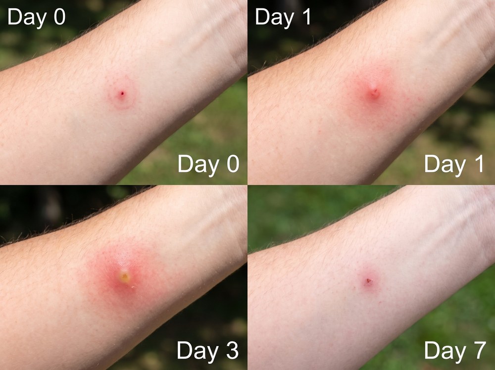 Four panel comparison image showing a garden spider bite healing progression from day zero through day seven